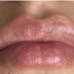 Lip Injections Before & After Patient #16633