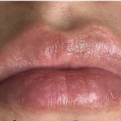 Lip Injections Before & After Patient #16633