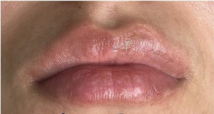 Lip Injections Before & After Patient #16633