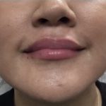 Lip Injections Before & After Patient #16616