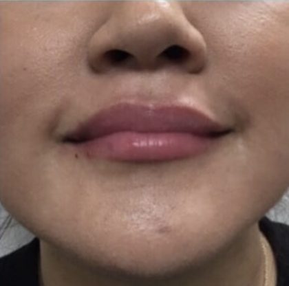 Lip Injections Before & After Patient #16616
