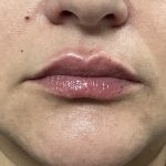 Lip Injections Before & After Patient #16634