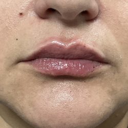 Lip Injections Before & After Patient #16634