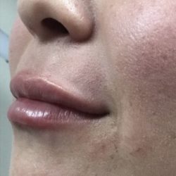 Lip Injections Before & After Patient #16614