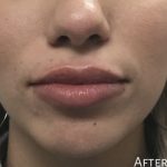 Lip Injections Before & After Patient #16617