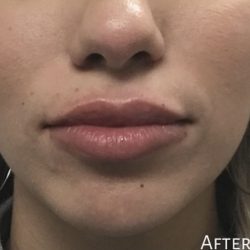 Lip Injections Before & After Patient #16617