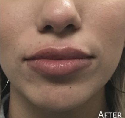 Lip Injections Before & After Patient #16617