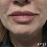 Lip Injections Before & After Patient #16618