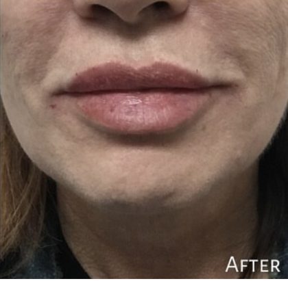 Lip Injections Before & After Patient #16618