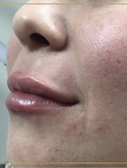 Lip Injections Before & After Patient #16614