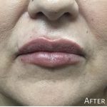 Lip Injections Before & After Patient #16619