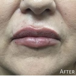 Lip Injections Before & After Patient #16619