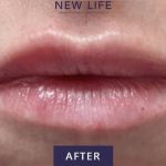 Lip Injections Before & After Patient #16620