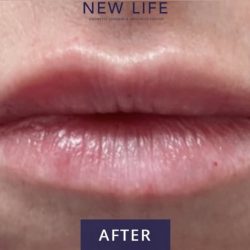 Lip Injections Before & After Patient #16620