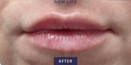Lip Injections Before & After Patient #16620