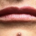 Lip Injections Before & After Patient #16621