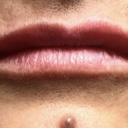 Lip Injections Before & After Patient #16621