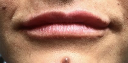 Lip Injections Before & After Patient #16621