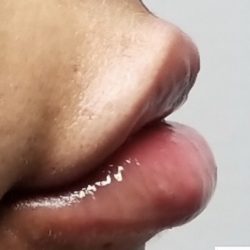 Lip Injections Before & After Patient #16622