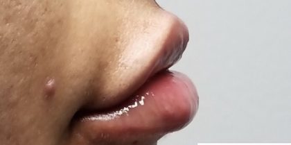 Lip Injections Before & After Patient #16622