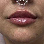 Lip Injections Before & After Patient #16623