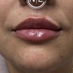 Lip Injections Before & After Patient #16623