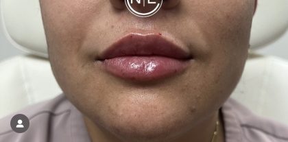Lip Injections Before & After Patient #16623