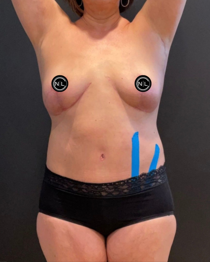 Abdominoplasty Before & After Patient #16563