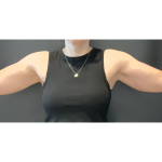 Brachioplasty Before & After Patient #16560
