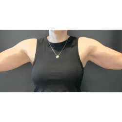 Brachioplasty Before & After Patient #16560