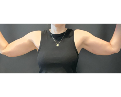 Brachioplasty Before & After Patient #16560