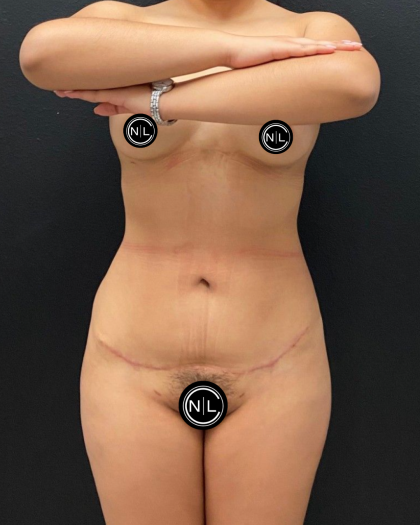 Liposuction Before & After Patient #16562
