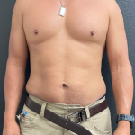 Weight Loss Before & After Patient #16530