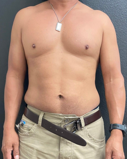 Weight Loss Before & After Patient #16530
