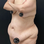 Tummy Tuck Before & After Patient #16527