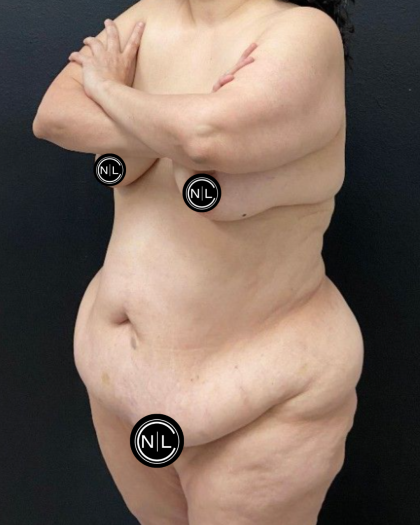 Tummy Tuck Before & After Patient #16527