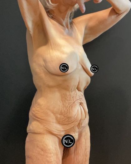 Abdominoplasty Before & After Patient #16559