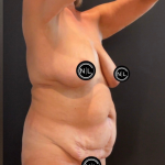 Abdominoplasty Before & After Patient #16563
