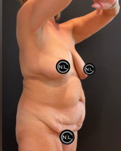 Abdominoplasty Before & After Patient #16563