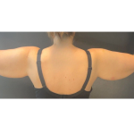 Brachioplasty Before & After Patient #16560