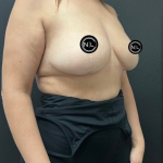 Breast Augmentation Before & After Patient #16528
