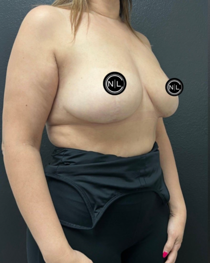 Breast Augmentation Before & After Patient #16528