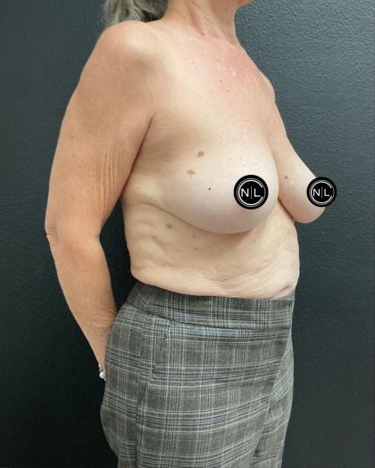 Breast Augmentation Before & After Patient #16529