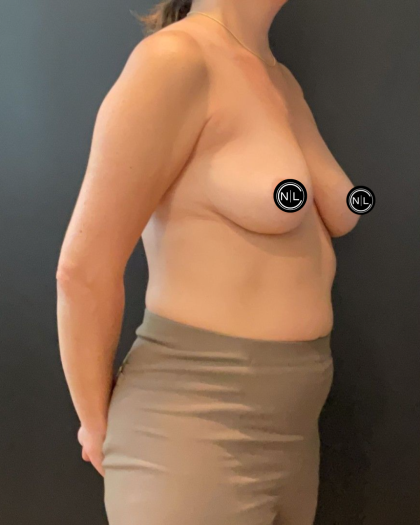Breast Augmentation Before & After Patient #16558