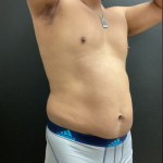 Weight Loss Before & After Patient #16530