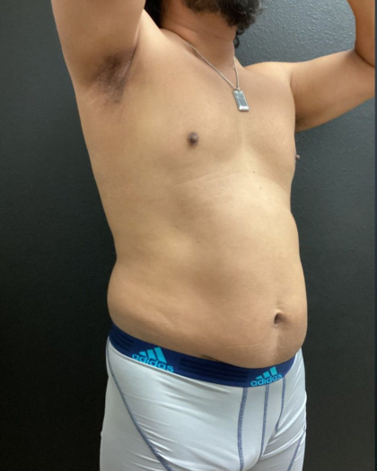 Weight Loss Before & After Patient #16530