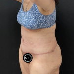 Tummy Tuck Before & After Patient #16527