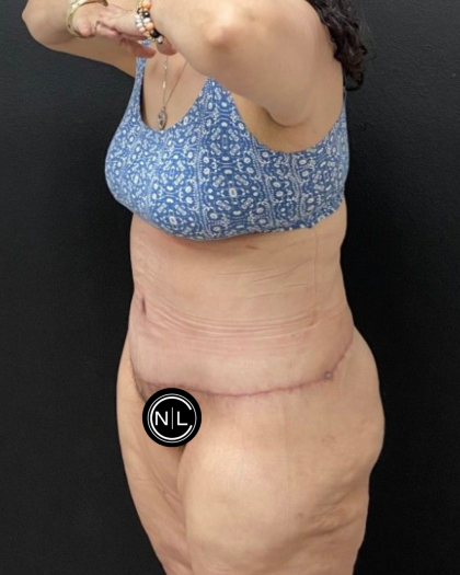 Tummy Tuck Before & After Patient #16527
