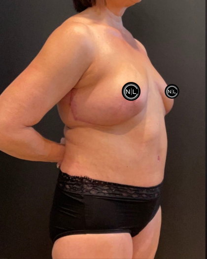 Abdominoplasty Before & After Patient #16563