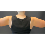 Brachioplasty Before & After Patient #16560